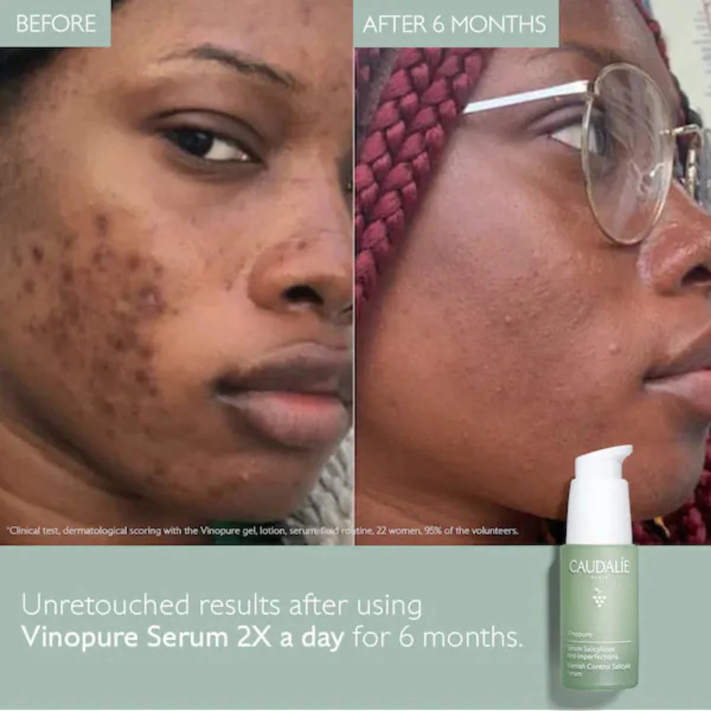 Caudalie Vinopure Skin Perfecting Serum for untouched results of blemish. 